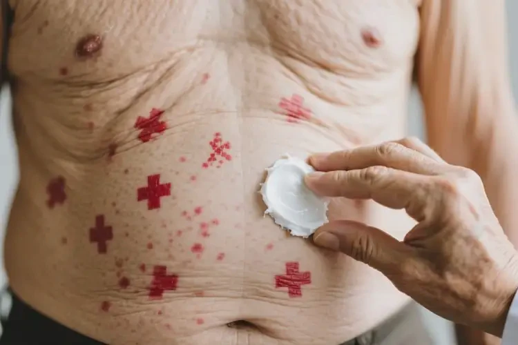 老人肚子起濕疹能夠徹底治愈嗎(圖2)