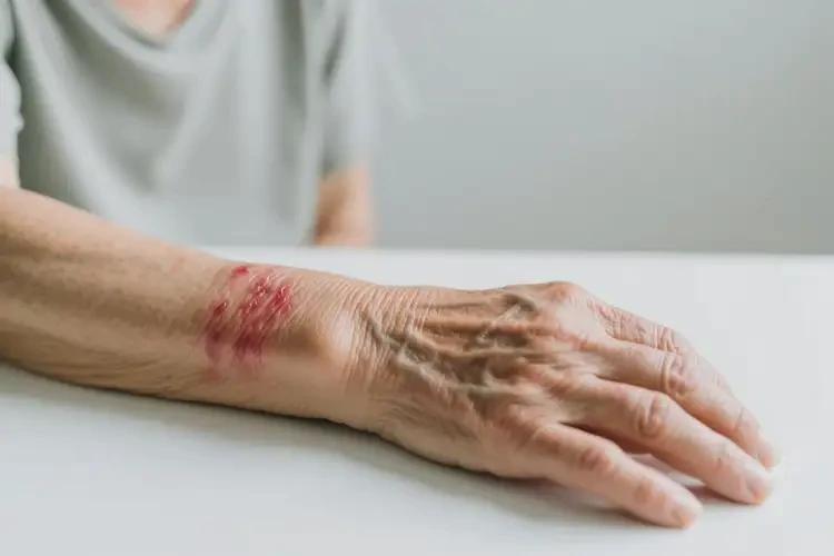 老年人手臂上出现湿疹不管它会自己痊愈吗(图4)