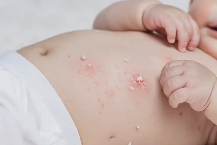 小兒肚子容易起濕疹能徹底自愈嗎(圖4)