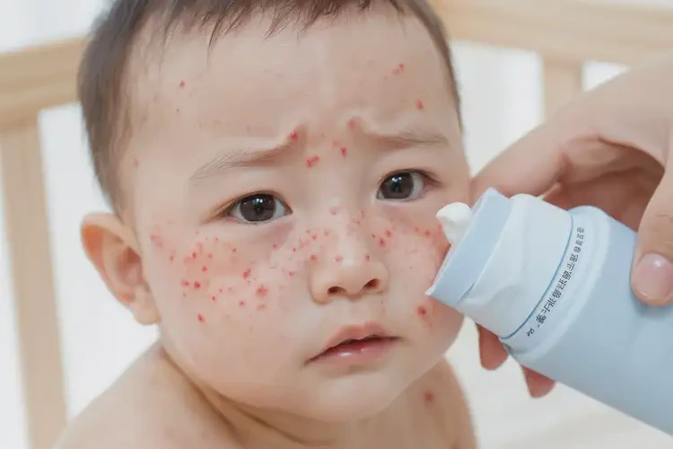 嬰兒身上出濕疹能夠徹底治愈嗎(圖3)