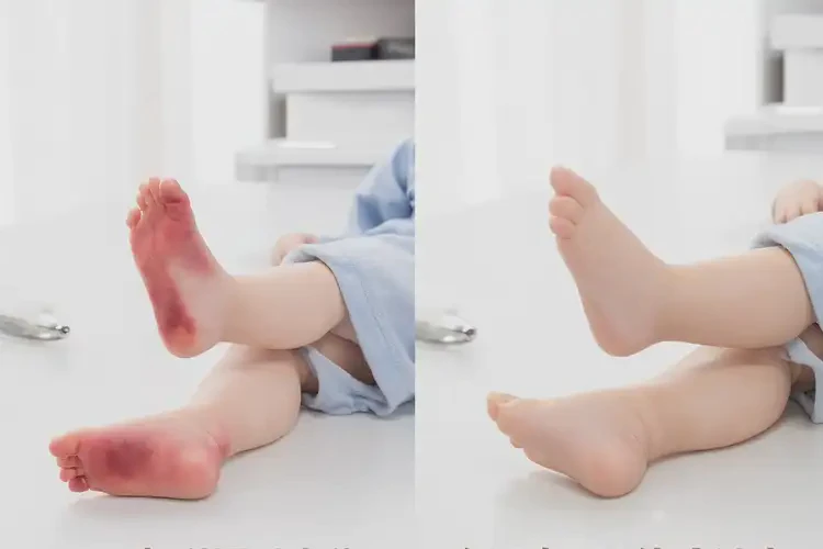 幼兒腳上長濕疹能夠徹底治愈嗎(圖2)