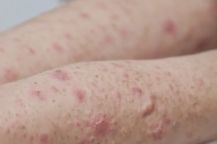 兒童手臂經(jīng)常長濕疹不管它會自己痊愈嗎(圖4)