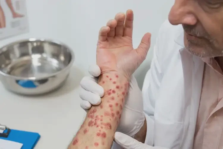 男人手上偶爾起濕疹可不可以徹底自愈(圖2)