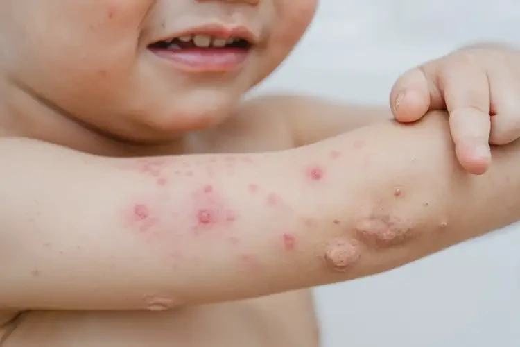 少兒屁股經(jīng)常長濕疹不管它會自己好嗎(圖4)