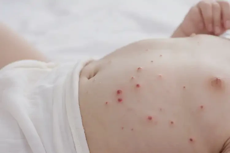 孩子肚子上容易起濕疹能徹底自愈嗎(圖4)