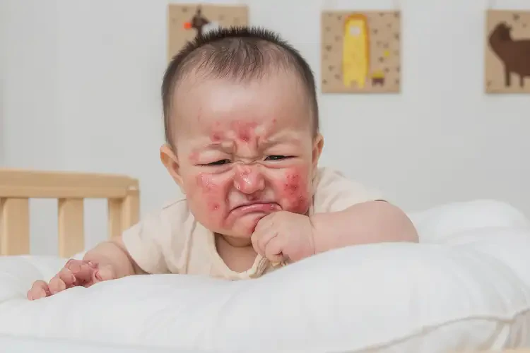 孩子臉上有濕疹不管它會自己自愈嗎(圖4)