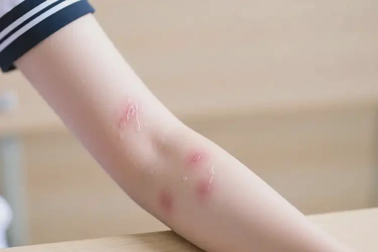 大學(xué)生手臂偶爾起濕疹不管它會(huì)自己好嗎(圖1)