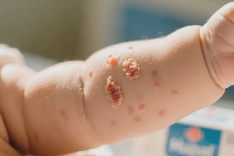 婴儿手臂出现湿疹不管它会自己好吗(图4)