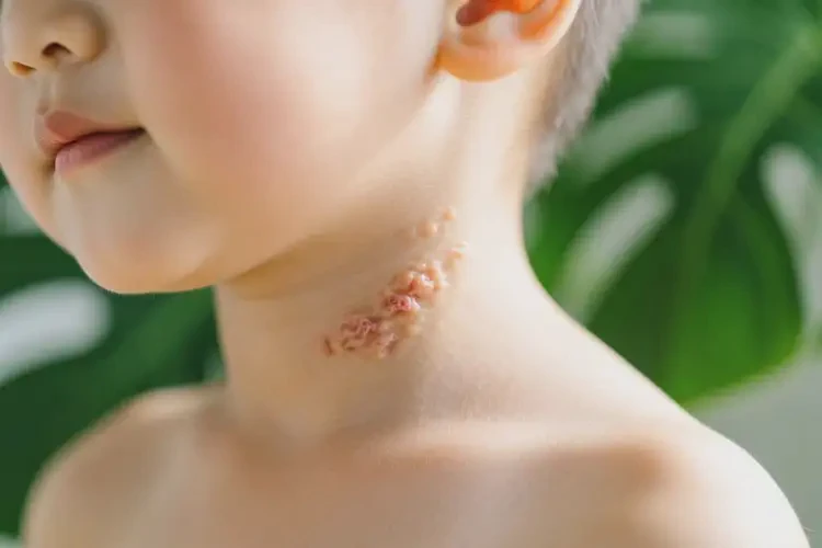 兒童脖子上有濕疹可以徹底自愈嗎(圖4)