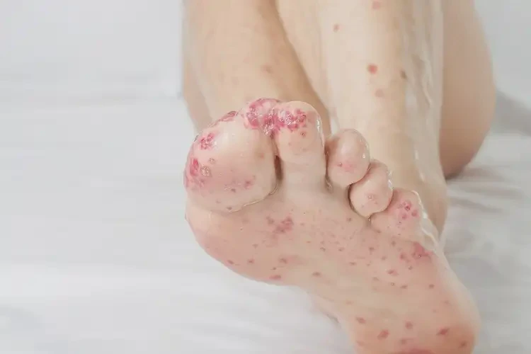 产妇脚上偶尔长湿疹不管它会自己痊愈吗(图4)