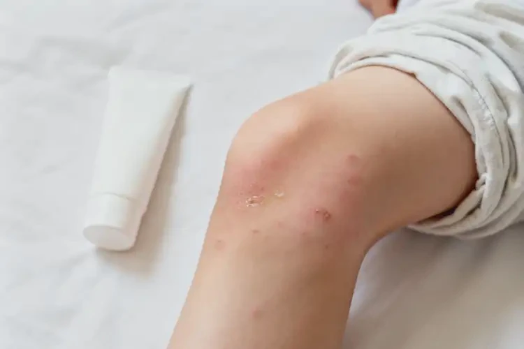 青少年大腿起濕疹可不可以徹底自愈(圖1)