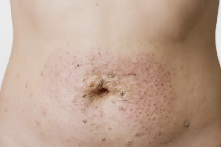 女人肚子經(jīng)常起濕疹不管它會自己痊愈嗎(圖3)