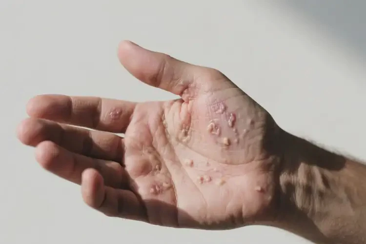 男性手上偶爾長(zhǎng)濕疹不管它會(huì)自己好嗎(圖1)