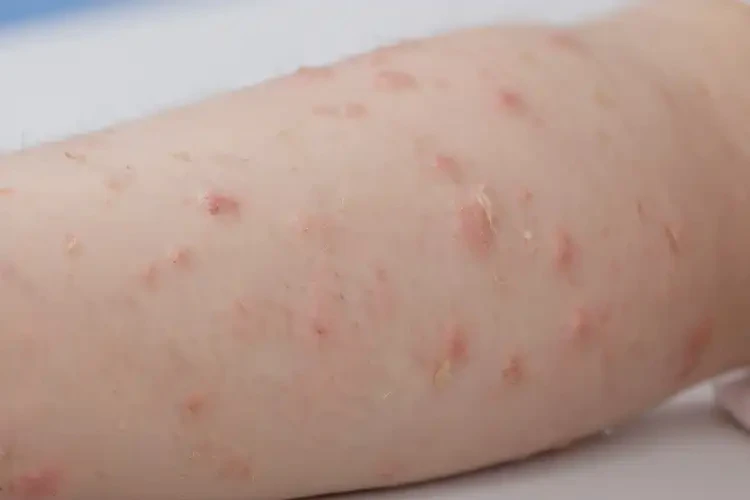 小學(xué)生手臂上偶爾起濕疹能徹底自愈嗎(圖4)