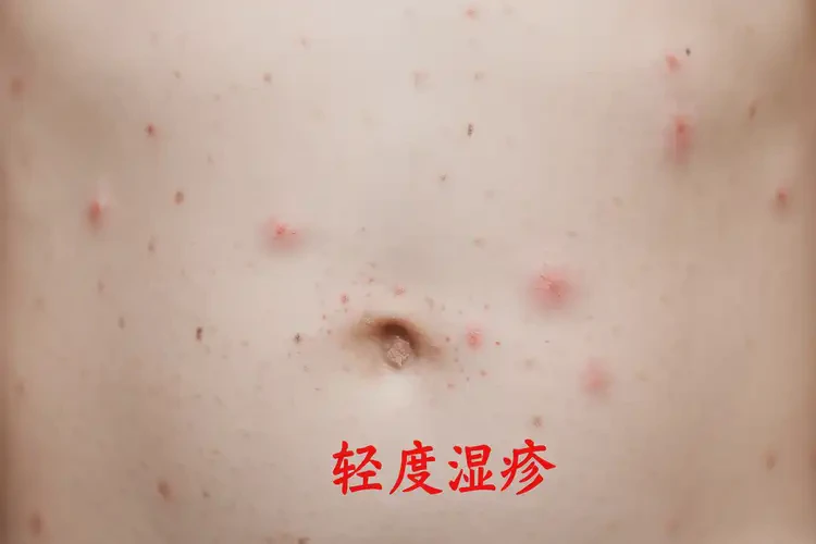 小孩肚子偶爾長濕疹可不可以徹底自愈(圖4)