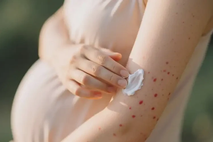 產(chǎn)婦全身出現(xiàn)濕疹可以徹底自愈嗎(圖4)