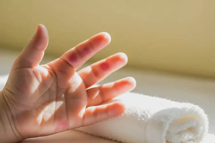 嬰幼兒手上有濕疹能夠徹底治愈嗎(圖4)