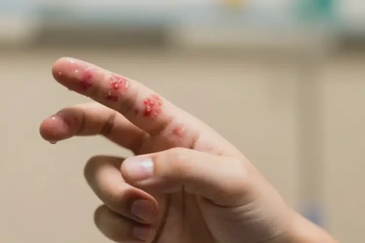 青少年手上經(jīng)常起濕疹不管它會自己好嗎(圖1)