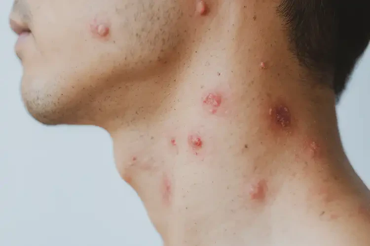 青年人脖子偶爾長(zhǎng)濕疹不管它會(huì)自己痊愈嗎(圖4)