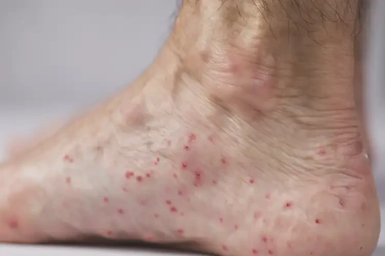 男性腳上容易起濕疹不管它會自己好嗎(圖4)