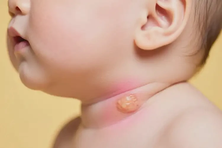 小兒脖子起濕疹不管它會自己痊愈嗎(圖1)