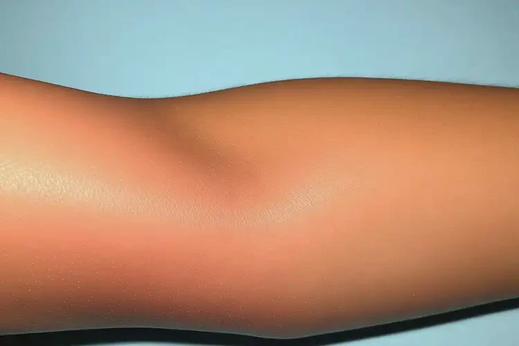 孕婦手臂出現(xiàn)濕疹可以徹底自愈嗎(圖3)