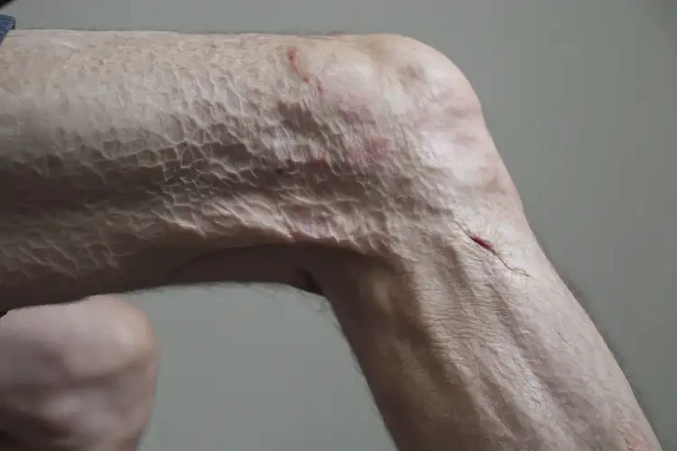 老人大腿上出现湿疹可以彻底自愈吗(图4)