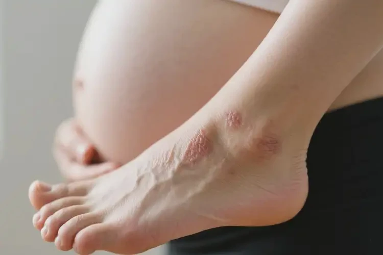 產(chǎn)婦腳上偶爾起濕疹不管它會自己痊愈嗎(圖4)