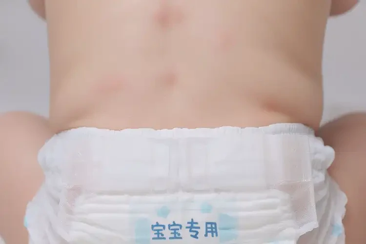 婴儿屁股上起湿疹不管它会自己好吗(图4)