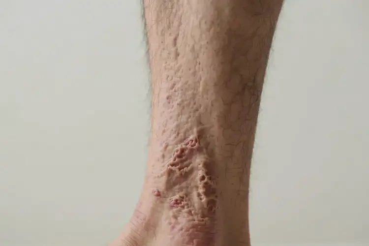 男生小腿上出現(xiàn)濕疹不管它會(huì)自己自愈嗎(圖1)