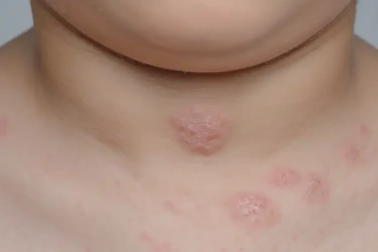 小兒脖子偶爾長濕疹可不可以徹底自愈(圖4)