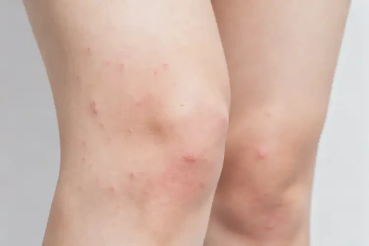 女人大腿上偶爾長濕疹能夠徹底治愈嗎(圖2)