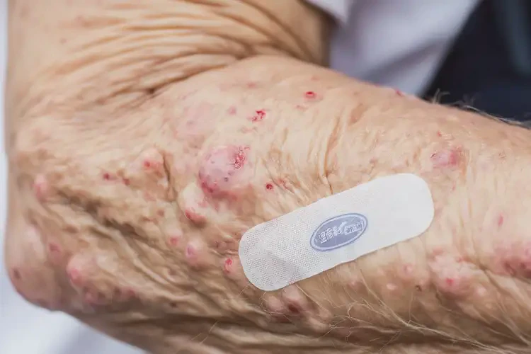 老年人手臂經(jīng)常長(zhǎng)濕疹可以徹底自愈嗎(圖4)