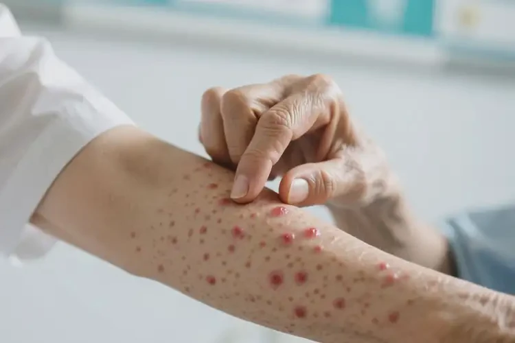 老年人手臂上經(jīng)常起濕疹不管它會自己自愈嗎(圖4)