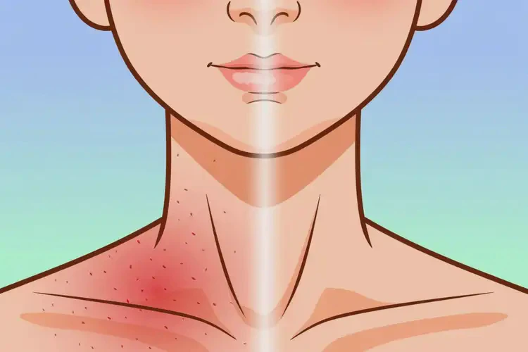 青少年脖子上容易長濕疹不管它會自己自愈嗎(圖4)