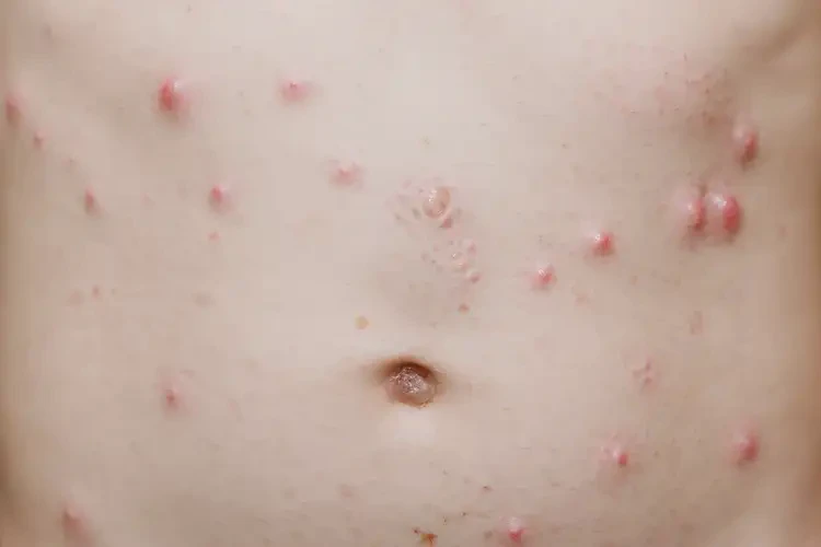 小學(xué)生肚子上出濕疹可以徹底自愈嗎(圖4)