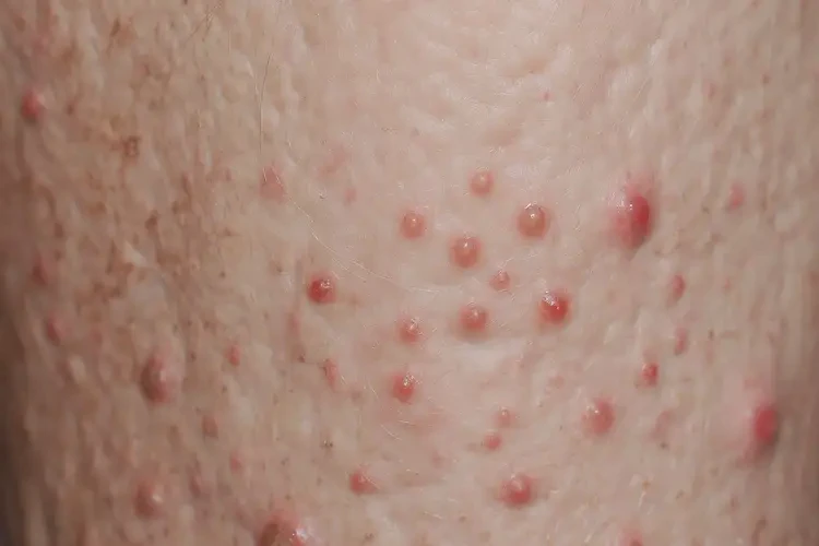 老人大腿长湿疹可以彻底自愈吗(图4)