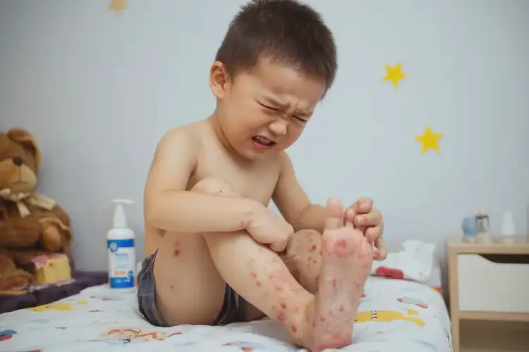 少兒小腿經常長濕疹能徹底自愈嗎(圖3)