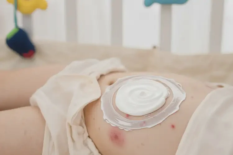 幼兒肚子偶爾起濕疹不管它會自己痊愈嗎(圖2)