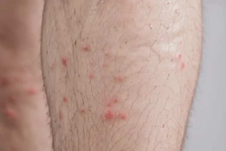 男生小腿容易长湿疹不管它会自己自愈吗(图4)