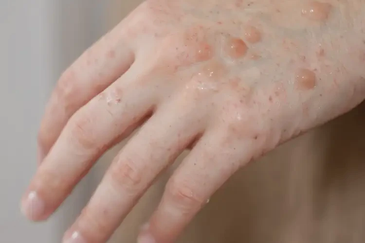 女人手上偶尔起湿疹不管它会自己自愈吗(图4)