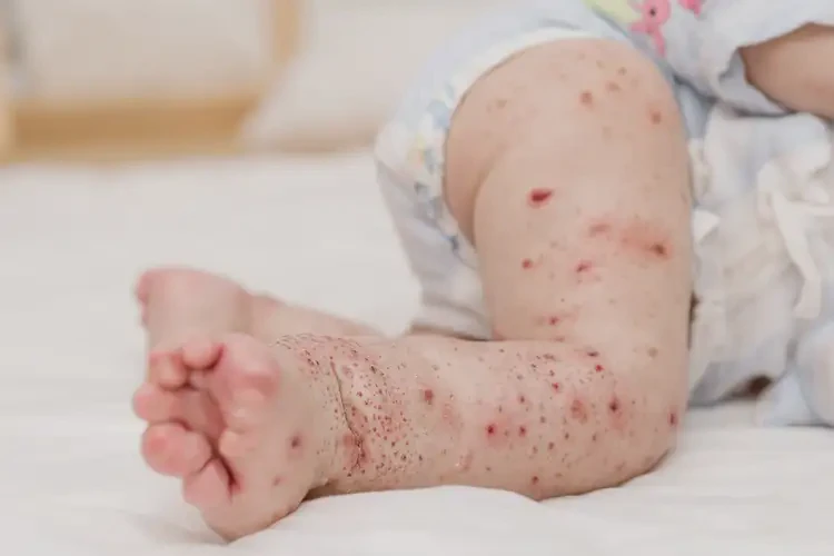 婴幼儿小腿上经常长湿疹能靠自己自愈吗(图4)