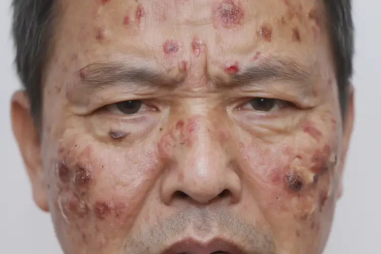 男人面部偶爾長濕疹不管它會自己自愈嗎(圖2)