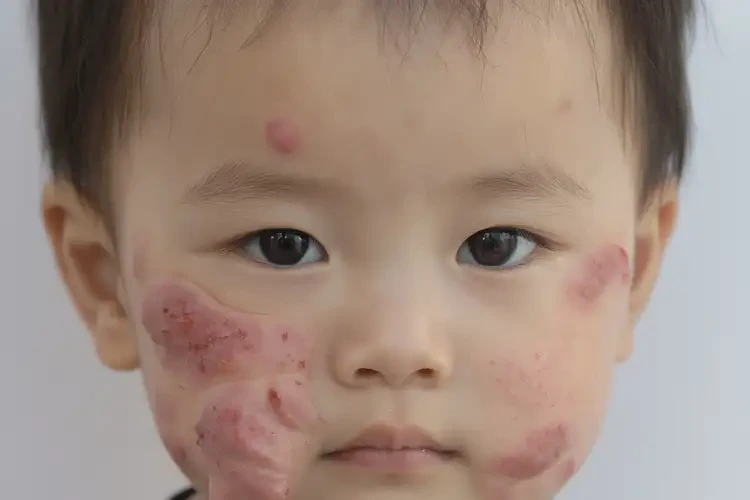 幼兒臉上經常起濕疹不管它會自己痊愈嗎(圖3)