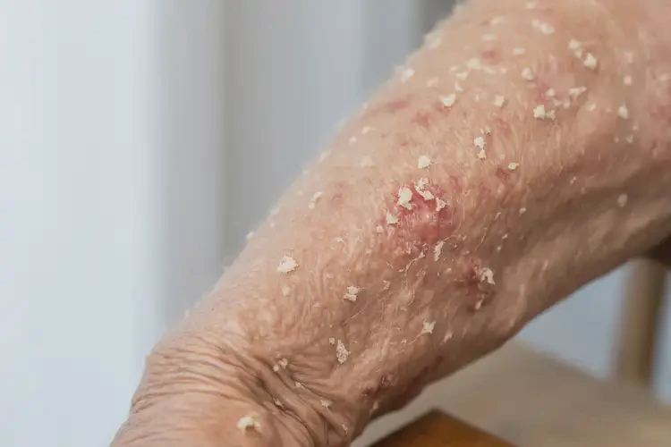 老人肛周有湿疹不管它会自己痊愈吗(图3)