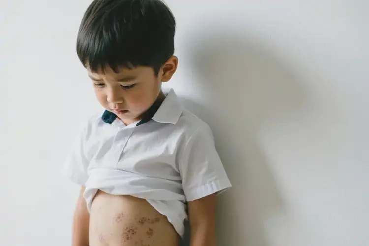 小孩肚子起濕疹不管它會(huì)自己痊愈嗎(圖1)