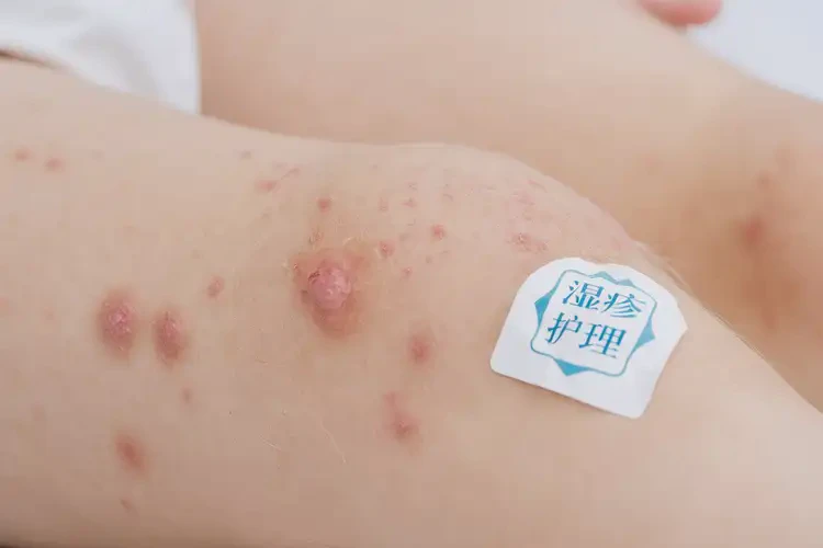 小兒大腿上出濕疹能夠徹底治愈嗎(圖4)