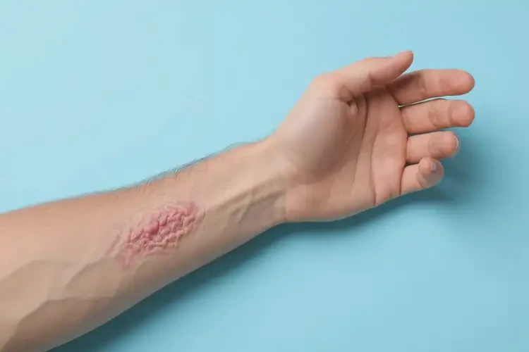 男生手臂上經(jīng)常長濕疹可以徹底自愈嗎(圖1)