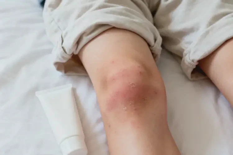 青少年大腿起濕疹可不可以徹底自愈(圖2)