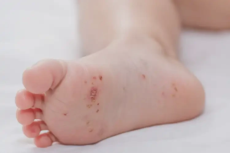 幼兒腳上偶爾起濕疹不管它會自己好嗎(圖4)